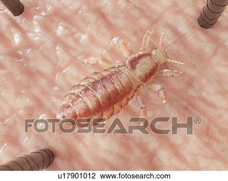 Stock Image - Head louse, computer illustration.. Fotosearch