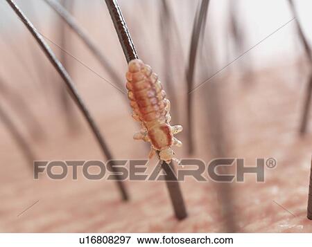 Stock Photo - Head louse, computer illustration.. Fotosearch