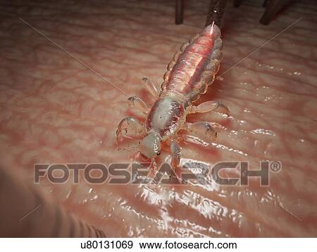 Stock Photo - Head louse, computer illustration.. Fotosearch