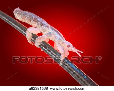 Stock Photo - Head louse, computer illustration.. Fotosearch