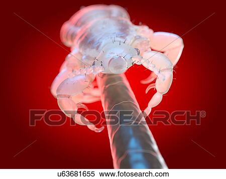 Head louse, computer illustration. View Large Photo Image Stock Photography - Head louse, computer illustration.. Fotosearch