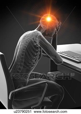 Stock Image - Headache, conceptual illustration.. Fotosearch