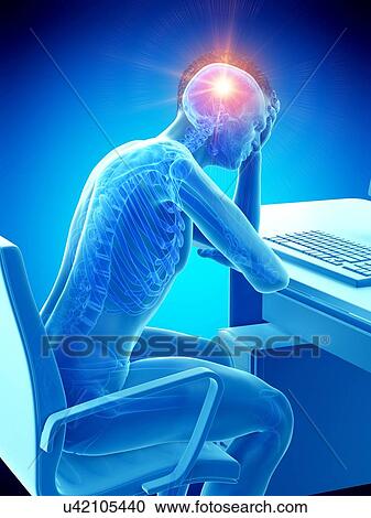 Stock Image - Headache, conceptual illustration.. Fotosearch