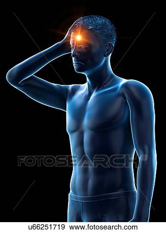 Stock Photo - Headache, conceptual illustration.. Fotosearch