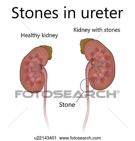 Stock Image - Healthy kidney, comparison with kidney with stones in ureter, illustration.. Fotosearch
