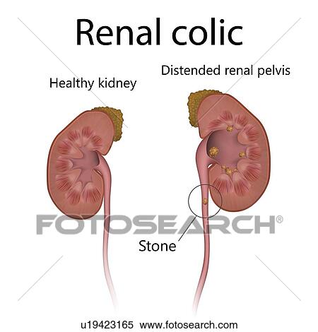 Stock Photography - Healthy kidney, comparison with renal colic, illustration. The kidney at right has a distended renal pelvis.. Fotosearch