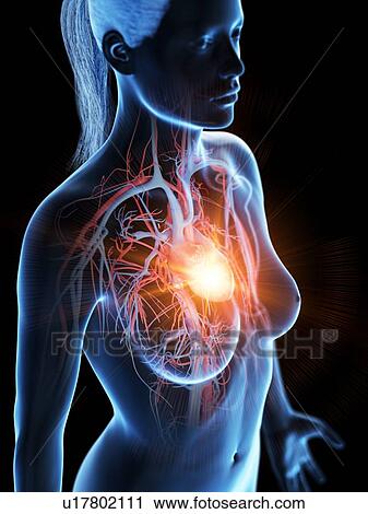 Stock Image - Heart attack, conceptual illustration. Fotosearch