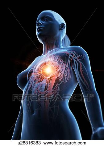 Stock Image - Heart attack, conceptual illustration. Fotosearch