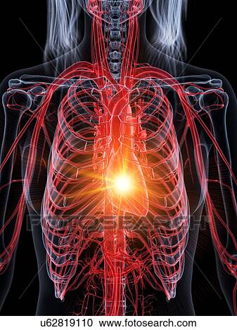 Stock Image - Heart attack, conceptual illustration. Fotosearch
