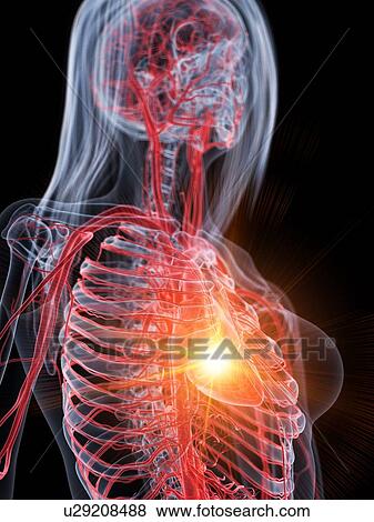 Stock Photo - Heart attack, conceptual illustration. Fotosearch