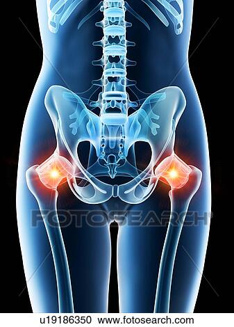 Stock Image - Hip pain, conceptual computer illustration.. Fotosearch