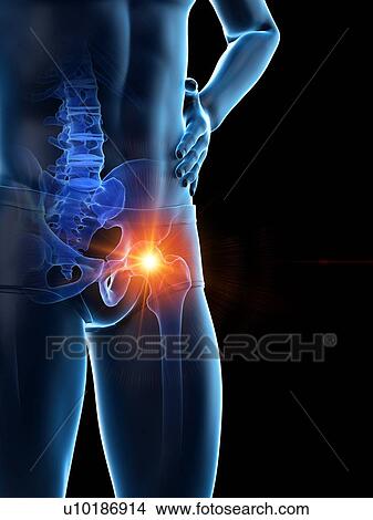Picture - Hip pain, conceptual illustration.. Fotosearch