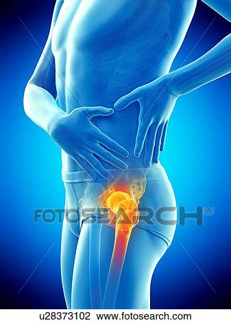 Stock Image - Hip pain, conceptual illustration.. Fotosearch