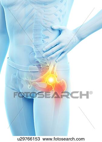 Stock Image - Hip pain, conceptual illustration.. Fotosearch