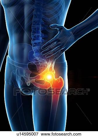 Stock Photo - Hip pain, conceptual illustration.. Fotosearch