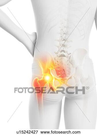 Stock Photo - Hip pain, conceptual illustration.. Fotosearch