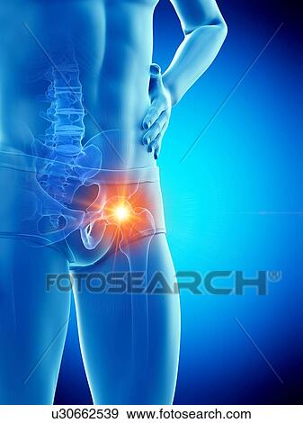 Stock Photo - Hip pain, conceptual illustration.. Fotosearch