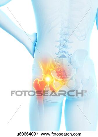 Stock Photo - Hip pain, conceptual illustration.. Fotosearch
