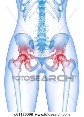 Stock Photo - Hip pain, conceptual illustration. Fotosearch
