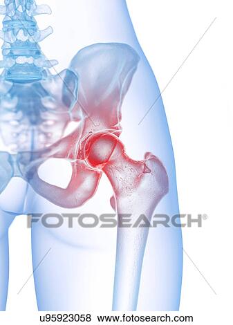 Stock Photo - Hip pain, conceptual illustration. Fotosearch