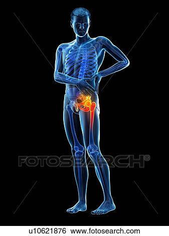 Hip pain, conceptual illustration. View Large Photo Image Stock Photograph - Hip pain, conceptual illustration.. Fotosearch