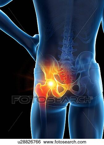 Stock Photograph - Hip pain, conceptual illustration.. Fotosearch