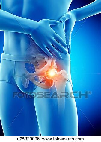 Stock Photograph - Hip pain, conceptual illustration.. Fotosearch