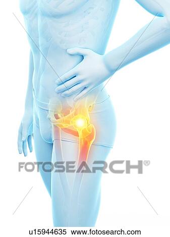 Stock Photography - Hip pain, conceptual illustration.. Fotosearch