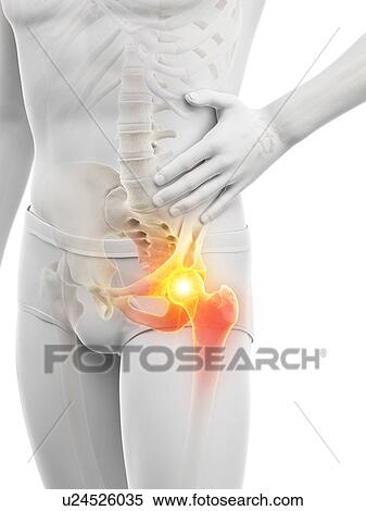 Stock Photography - Hip pain, conceptual illustration.. Fotosearch