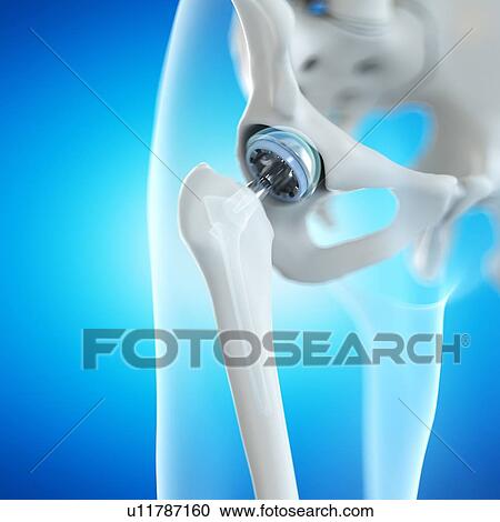 Hip replacement, computer illustration. View Large Photo Image Stock Image - Hip replacement, computer illustration.. Fotosearch