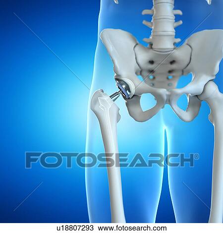 Stock Image - Hip replacement, computer illustration.. Fotosearch