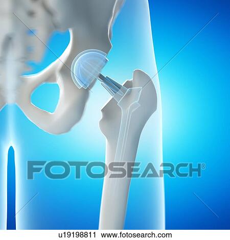 Stock Image - Hip replacement, computer illustration.. Fotosearch