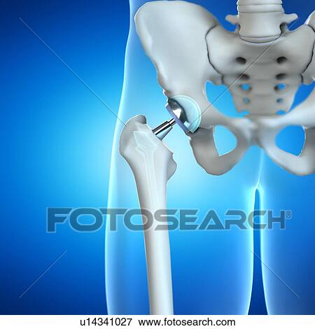 Stock Photo - Hip replacement, computer illustration.. Fotosearch