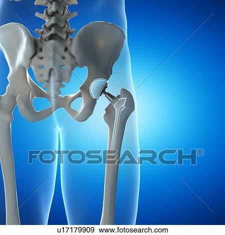 Hip replacement, computer illustration. View Large Photo Image Stock Photo - Hip replacement, computer illustration.. Fotosearch