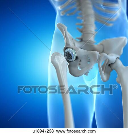 Stock Photo - Hip replacement, computer illustration.. Fotosearch