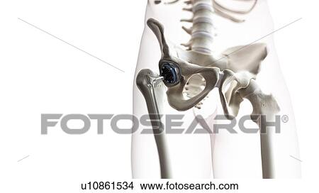 Hip replacement, illustration View Large Photo Image Picture - Hip replacement, illustration. Fotosearch
