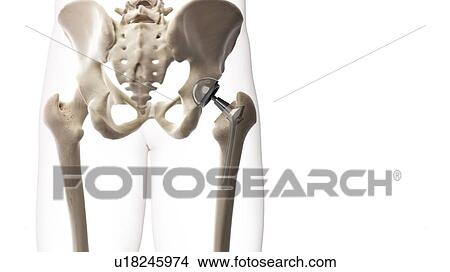 Picture - Hip replacement, illustration. Fotosearch