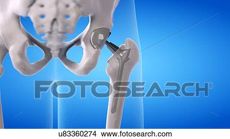 Picture - Hip replacement, illustration. Fotosearch