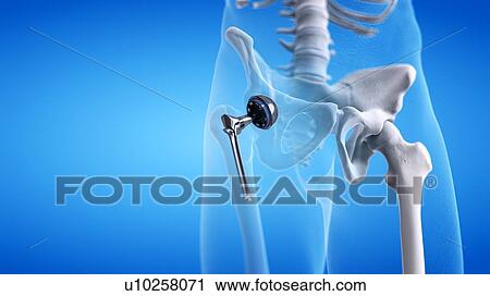 Stock Image - Hip replacement, illustration. Fotosearch