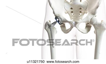 Hip replacement, illustration View Large Photo Image Stock Image - Hip replacement, illustration. Fotosearch
