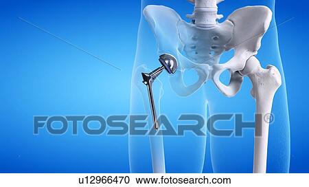 Hip replacement, illustration View Large Photo Image Stock Image - Hip replacement, illustration. Fotosearch