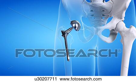 Stock Image - Hip replacement, illustration. Fotosearch