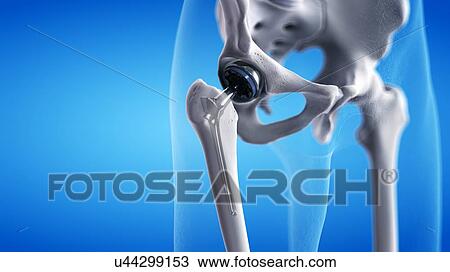 Stock Image - Hip replacement, illustration. Fotosearch