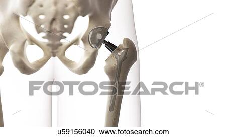 Hip replacement, illustration View Large Photo Image Stock Image - Hip replacement, illustration. Fotosearch