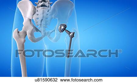 Stock Image - Hip replacement, illustration. Fotosearch