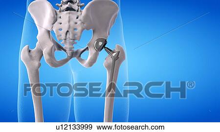 Stock Photo - Hip replacement, illustration. Fotosearch