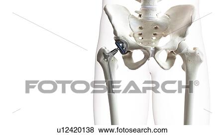 Stock Photo - Hip replacement, illustration. Fotosearch