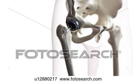 Hip replacement, illustration View Large Photo Image Stock Photo - Hip replacement, illustration. Fotosearch