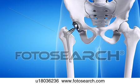 Stock Photograph - Hip replacement, illustration. Fotosearch