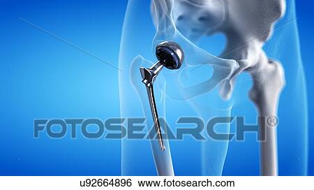 Stock Photograph - Hip replacement, illustration. Fotosearch